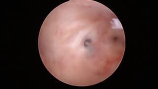 Histeroscopia diagnóstica /  Diagnostic hysteroscopy