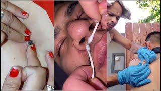 Popping Huge Blackheads and Pimple Popping - Best Pimple Popping Videos 20