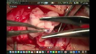 Separating oral mucosa from the salivary glands