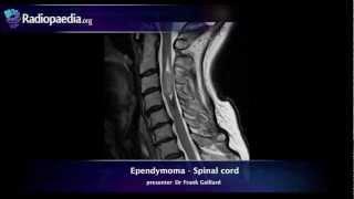 Spinal ependymoma - radiology video tutorial (MRI)