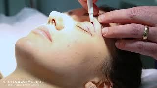 Upper Blepharoplasty Eyelid Lift Surgery | Watch The Procedure | Mr Robert Bains