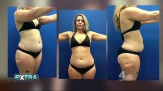 Elite Body Sculpture - ExtraTV Talks With EBS and Reviews Their AirSculpt® Procedures