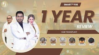 1-Year Review After SMART™ FUE | GLOJAS AESTHETIC CLINIC