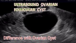 TVS Ultrasound Ovarian Follicular Cyst , Difference with Ovarian Cyst , is This Serious?? .