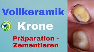 Vollkeramik-Krone im Seitenzahnbereich | Patientenfall,  Präparation, Einsetzen