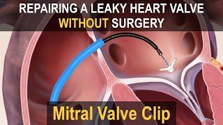 MITRACLIP (Mitral Valve Clip) | Repairing a Leaky Heart Valve without Surgery