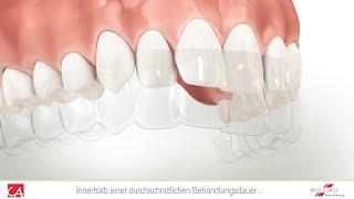 Korrektur von Zahnfehlstellung mit unsichtbarer Schiene