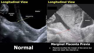 Obstetric Ultrasound Normal Pregnancy Vs Placenta Previa | Low-Lying, Marginal, Partial, Complete