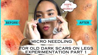 MICRO NEEDLING FOR OLD DARK SCARS ON LEGS  EXPERIMENTATION  PART 1