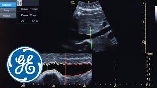 Venue Ultrasound Auto Workflows | GE Healthcare