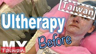 Ultherapy in Taiwan, Part 1 Before