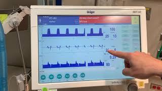 Introduction to a Drager Ventilator