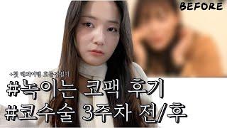 코수술 전후 /  콧속 연골 튀어나옴?? / 원데이즈유 피지연화제 후기 / 첫 해외여행 전 호들갑떨기