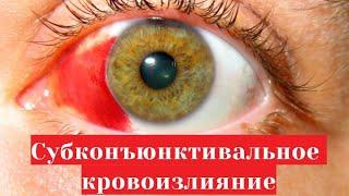 Субконъюнктивальное кровоизлияние (красное пятно на белке) - когда лопнул сосуд на глазу 
