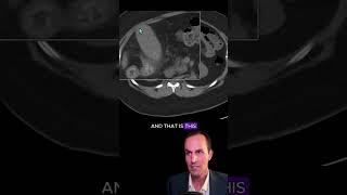 Cholecystitis on abdominal CT #radiology #medicalstudent #radiologist #radiographer