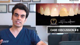 Case Discussion 6 - Composite Veneer for Discolored Tooth