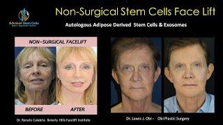 GCELL- The Stem Cell Face Lift - A  Simplified Procedure in less than 60 minutes