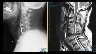 Cervical disc herniations after fusion