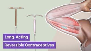 Long-Acting Reversible Contraceptives (LARCs) | TVASurg