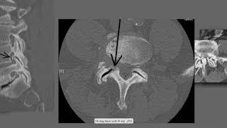 How to Read the CT Scans | How to Read CT Myelograms | How to Read Spine Imaging