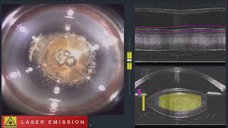 Dr Swapna Nair Flacs In Subluxated Cataracts