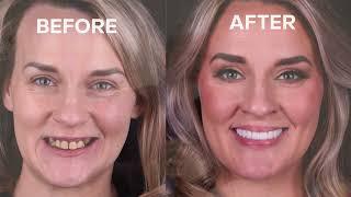 How Dental Implants can Change Your Life.
