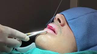 Lip Reduction in Edgewater, NJ by Top Plastic Surgeon