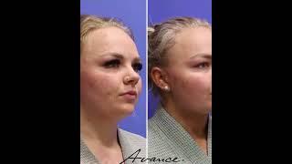 Reno NV Neck Liposuction with FaceTite | Neck Lipo Before & After | Avance Plastic Surgery Institute