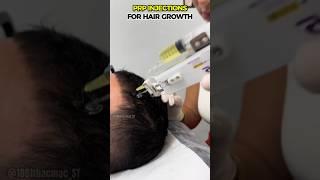 PRP Injections for Hair Growth: Solution or Scam? #shorts