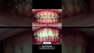 24 month braces process  #dentist #braces #orthodontist