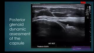 Ultrasound Inf Glenohumeral Lig in Adhesive Capsulitis of the Shoulder