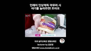 MJTV(엠제이티비)  인레이 인상채득 마무리 시 여기를 눌러주면 좋아요