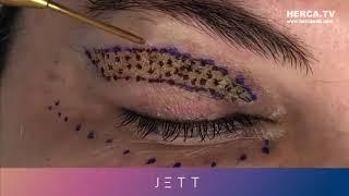 Jett Plasma Lift Medical - Blefaroplastia - HERCA