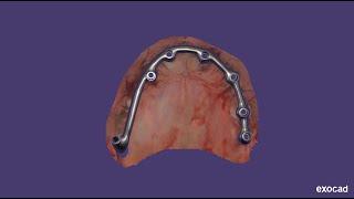 Upper all on 7 titanium bar designing for MU screw retained implant in exocad elefsina