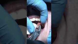 Tooth extraction for orthodontic purposes #shorts #dentist #slowmo