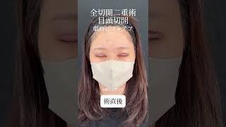 【劇的変化】埋没したけど取れた‼️目頭切開×全切開二重術で別人級美人に #美容整形 #目頭切開 #美容クリニック #美容 #全切開二重術 #埋没法