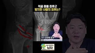 척골 충돌 증후군 방치되면 어떻게 될까? #척골충돌증후군 #올바른서울병원 #shorts