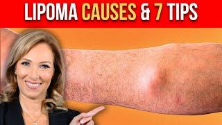 Lipoma Causes : 7 Tips to Get Rid of Them | Dr. Janine