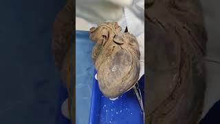 Left Ventricle