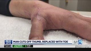 Doctors use man’s toe to recreate sawed-off thumb