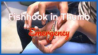 Fishhook Stuck in Thumb Emergency
