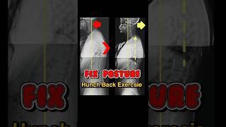 Hunch back Exercise. Hyper Kyphosis Exercise.