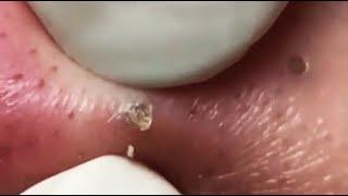 WOOW !! BLACKHEADS REMOVAL FROM THE NOSE  #relaxing  #blackheads