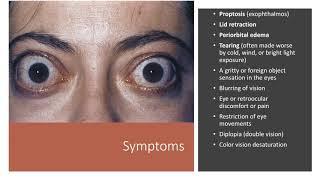 Thyroid Eye Disease