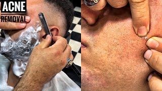 ASMR BEARD SHAVE • Subcutaneous acne removal • Barber Massage • SLEEP