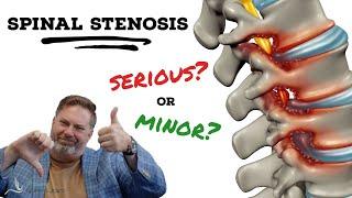 Is Spinal Stenosis serious? | The Clinic: Episode 1