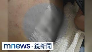 病患控新光醫院開錯刀　反遭醫指責不自費電漿刀｜#鏡新聞