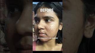 How to use Tretinoin Cream for most effective results Tretinoin before and after skin transformation