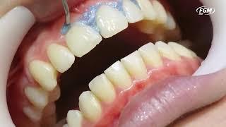 Caso clínico: clareamento dental com Whiteness HP AutoMixx 35% PLUS e White Class 7,5%