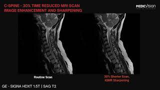 C-spine - 30% time reduced MRI scan. iQMR Image Enhancement and Sharpening